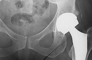 hip_replacement